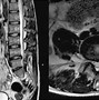 Image result for Disc Herniation Types
