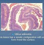 Image result for Filiform Polyp