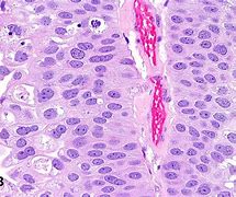 Image result for Papillary Bladder Cancer