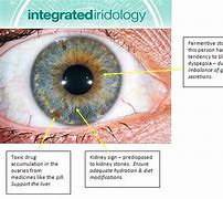 Image result for Anemia Ring Iris