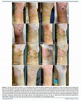 Image result for Healing Burn Blister