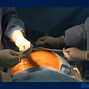 Image result for Midline Catheter Placement