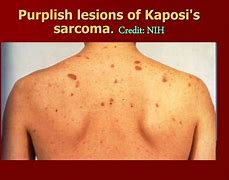 Image result for Types of Kaposi Sarcoma