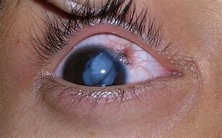 Image result for Fish Hook in Eye
