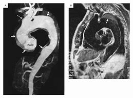 Image result for aortitis