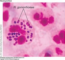 Image result for Disseminated Gonorrhea