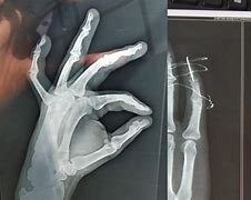 Image result for Wiring Broken Fingers