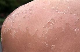 Image result for Skin Cancer From SunBurn