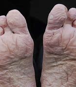 Image result for Rotting Feet
