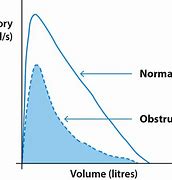 Image result for Obstructive Spirometry
