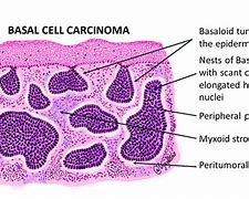 carcinoma cell 的图像结果