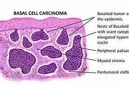 Image result for Micronodular Basal Cell Carcinoma