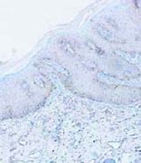 Image result for Vulvar Molluscum