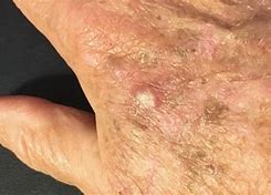 Image result for Actinic Keratosis