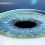 Image result for Lasik Op