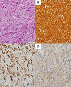 Image result for Angiosarcoma