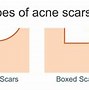 Image result for Acne Scars Cheeks