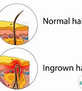 Image result for Ingrown Hair Stomach