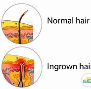 Image result for Cancer or Ingrown Hair
