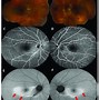 Image result for Retinal Thinning