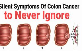 Image result for Stage 4 Colon Cancer Signs