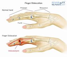 Image result for Dislocated Pinky Finger