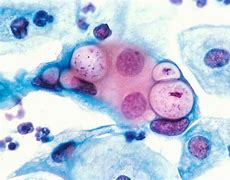 Image result for Chlamydia Pneumoniae