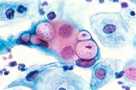 Image result for Chlamydia On Face