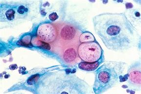 Image result for Chlamydia Cyst