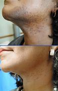 Image result for Laser Hair Removal Before and After