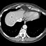 Image result for Carcinoid Tumor CT
