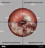Image result for How Big Is 4 Cm Tumor