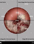Image result for What Does Cervical Cancer Look Like