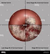 Image result for Cervical Cancer Colposcopy