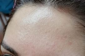 Image result for Small Raised Bumps On Forehead