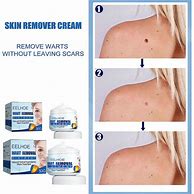 Image result for Neck Wart Removal Treatments Cream