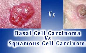 Image result for Squamous Cell On the Lip