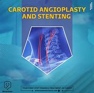 Image result for Angioplasty Carotid Artery Stent