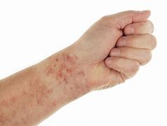 Image result for Actinic Purpura