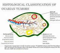 Image result for Epithelial Ovarian Tumors List