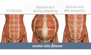 Image result for Diastasis Recti Newborn