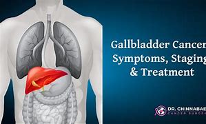 Image result for Gallbladder Cancer Staging