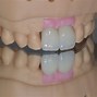 Image result for Front Teeth Bone Loss