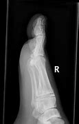 Image result for Lisfranc Fracture