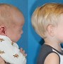 Image result for Craniosynostosis Uncommon Birth Defect