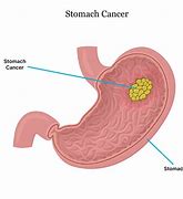 Image result for Stomach Cancer Tumor Size
