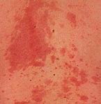 Image result for Psoriasis