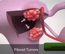 Image result for 8 cm fibroids removal