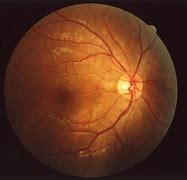 Image result for Normal Ocular Fundus