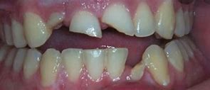 Image result for Cricket Teeth
